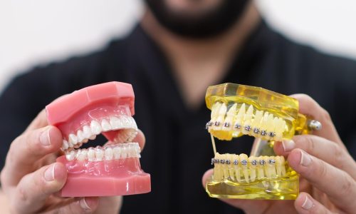 Los alineadores transparentes ofrecen mejores resultados que los brackets