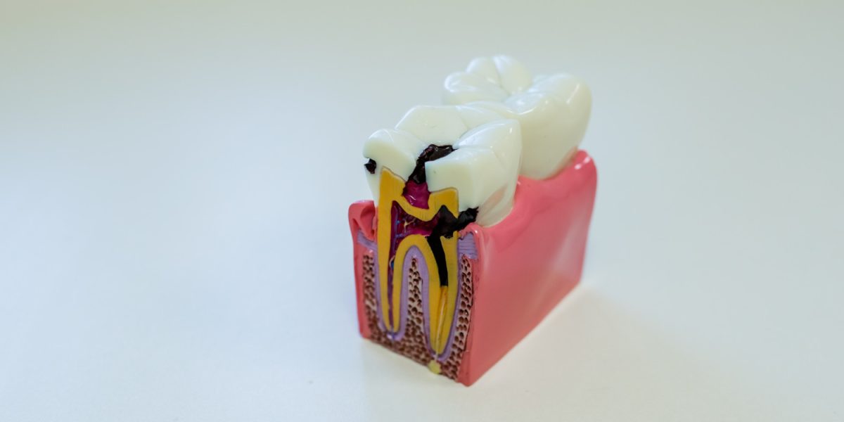 que son las caries